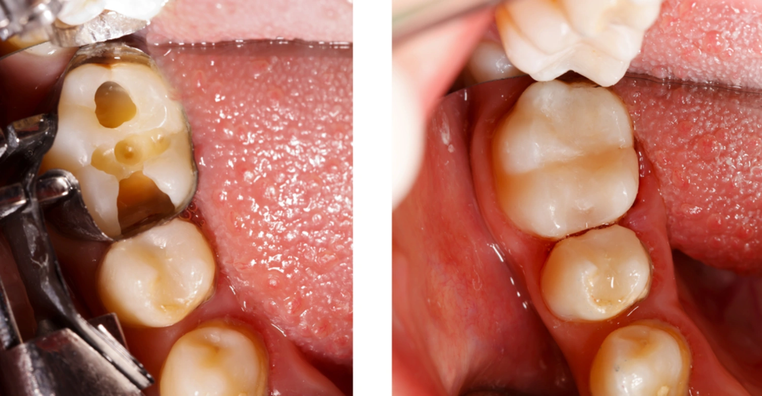 Root Canal for Cracked Tooth Inblog